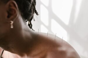 Chinese Medicine Certification - Detailed view of acupuncture needles applied to a shoulder for therapeutic treatment.