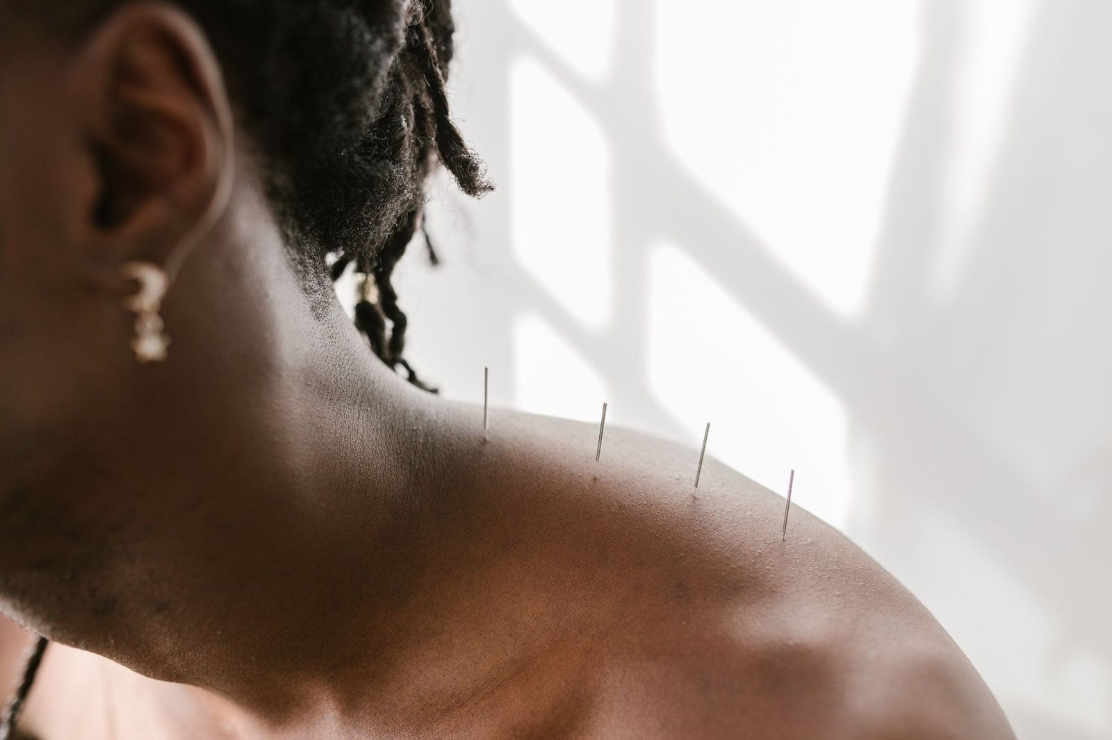 Chinese Medicine Certification - Detailed view of acupuncture needles applied to a shoulder for therapeutic treatment.